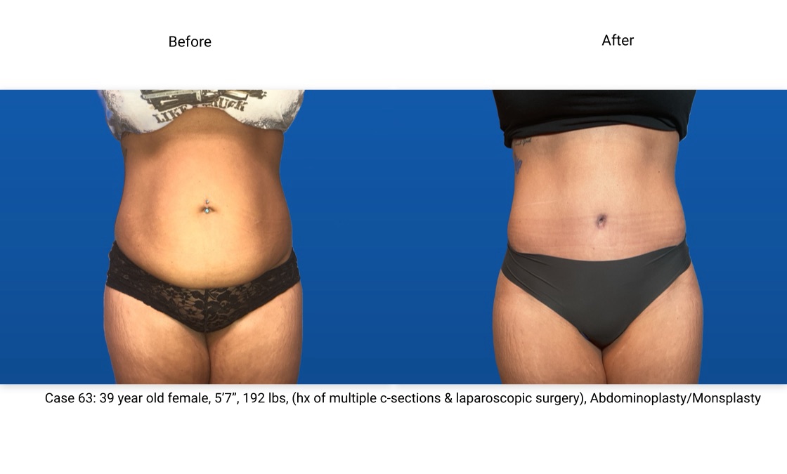 Case 63 Abdominoplasty Front View