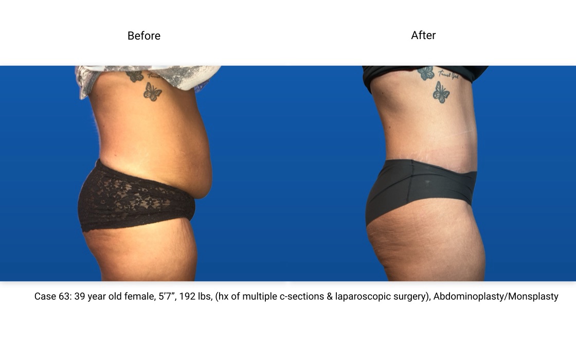 Case 63 Abdominoplasty Side View