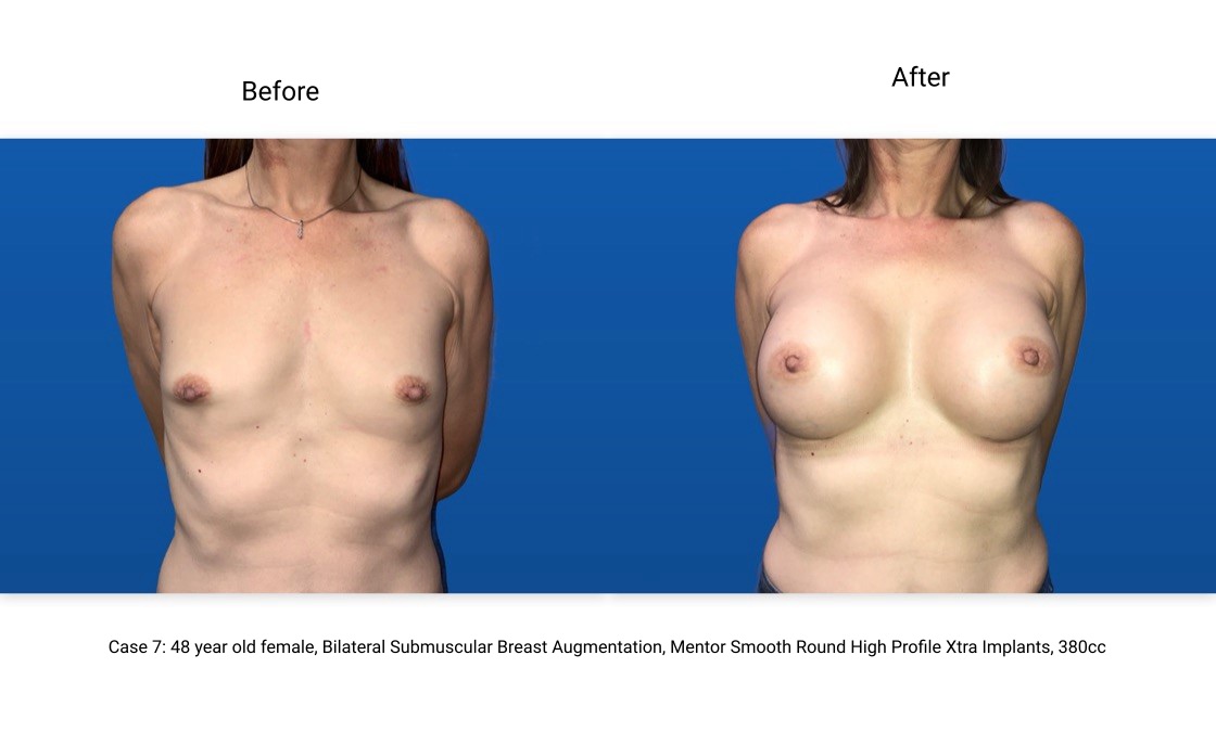 Case 7 Breast Augmentation Front View