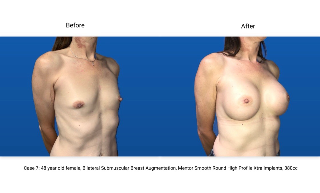 Case 7 Breast Augmentation 3/4 View