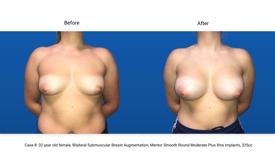 Case 8 Breast Augmentation Front View