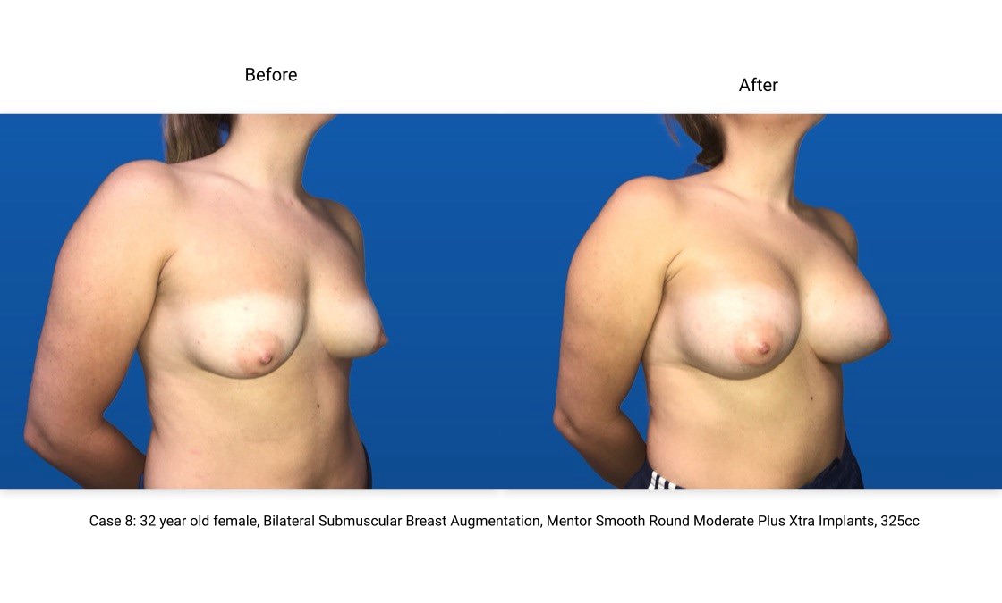 Case 8 Breast Augmentation 3/4 View