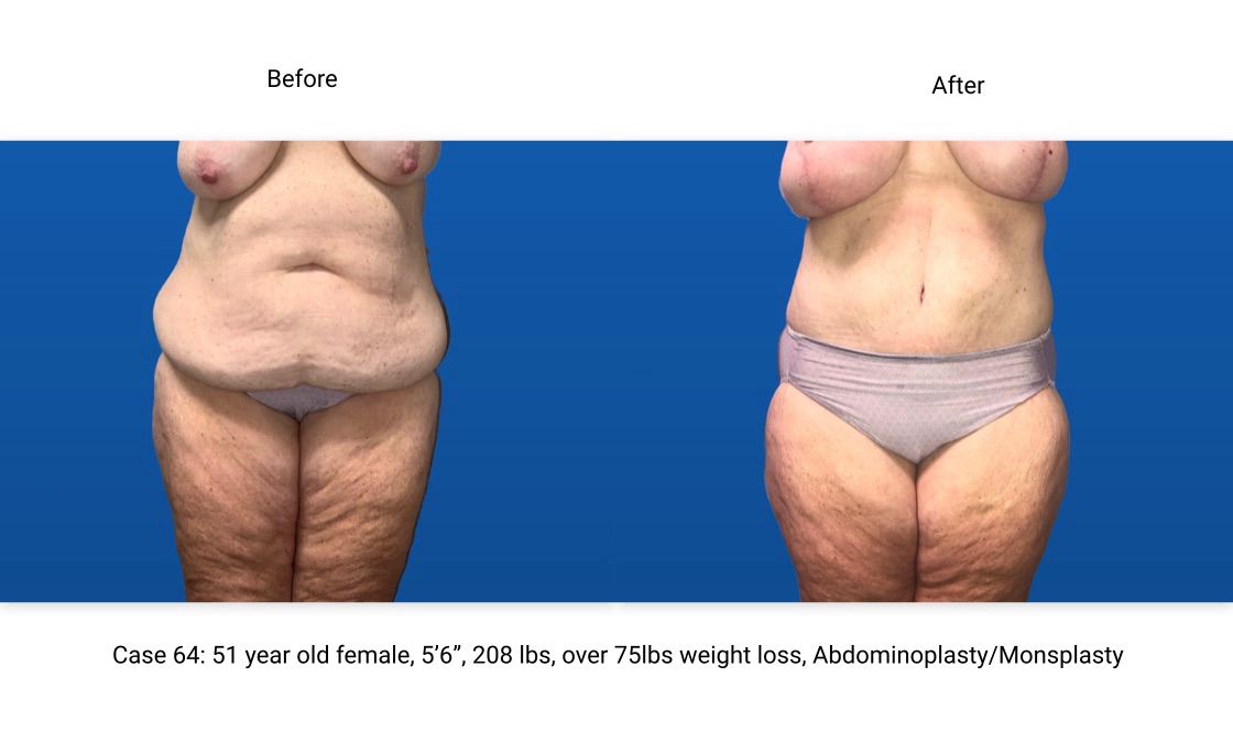 Case 64 Abdominoplasty Front View