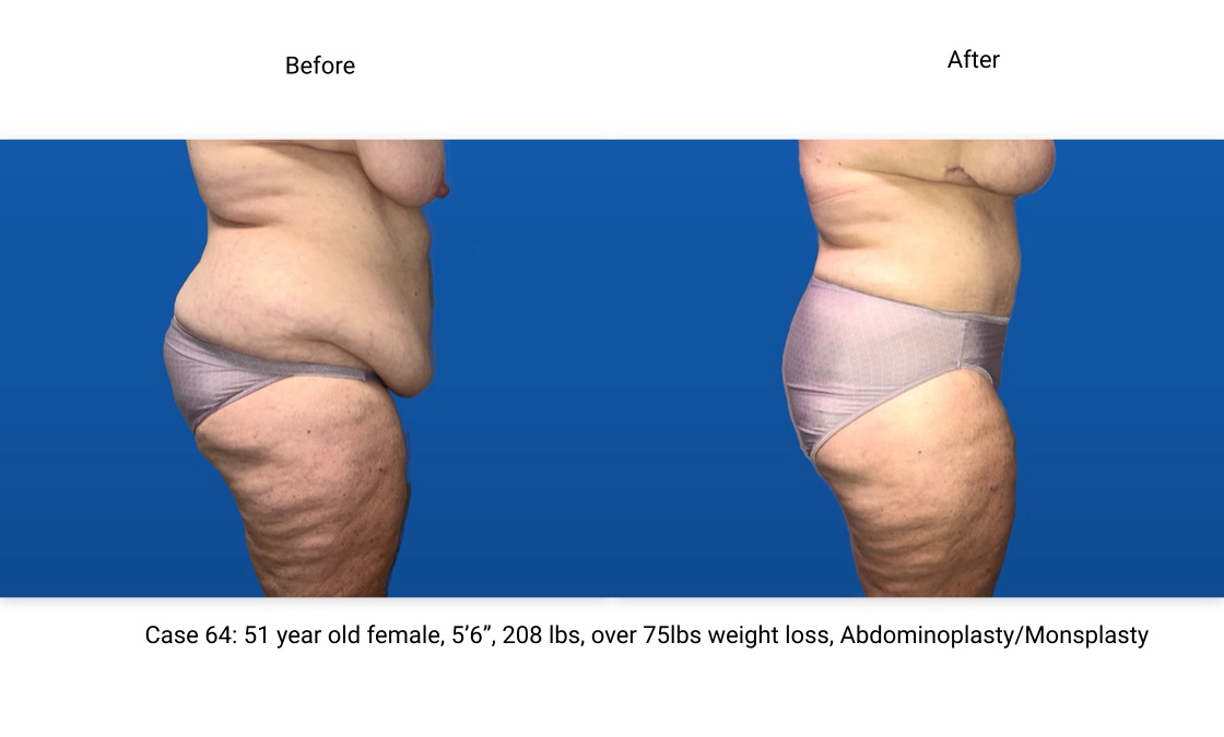 Case 64 Abdominoplasty Side View