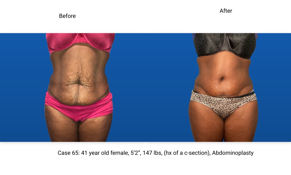 Case 65 Abdominoplasty Front View