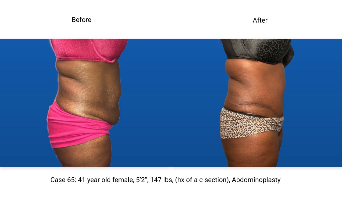 Case 65 Abdominoplasty Side View
