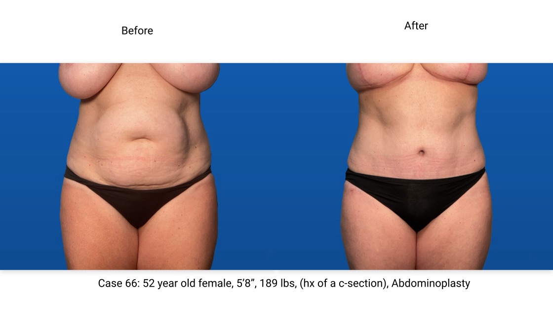 Case 66 Abdominoplasty Front View
