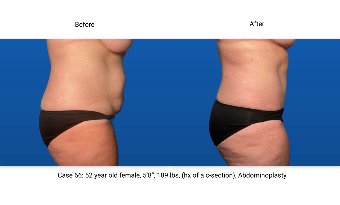 Case 66 Abdominoplasty Side View