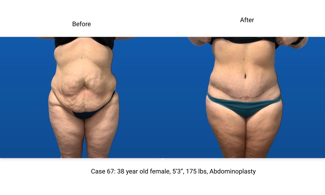 Case 67 Abdominoplasty Front View