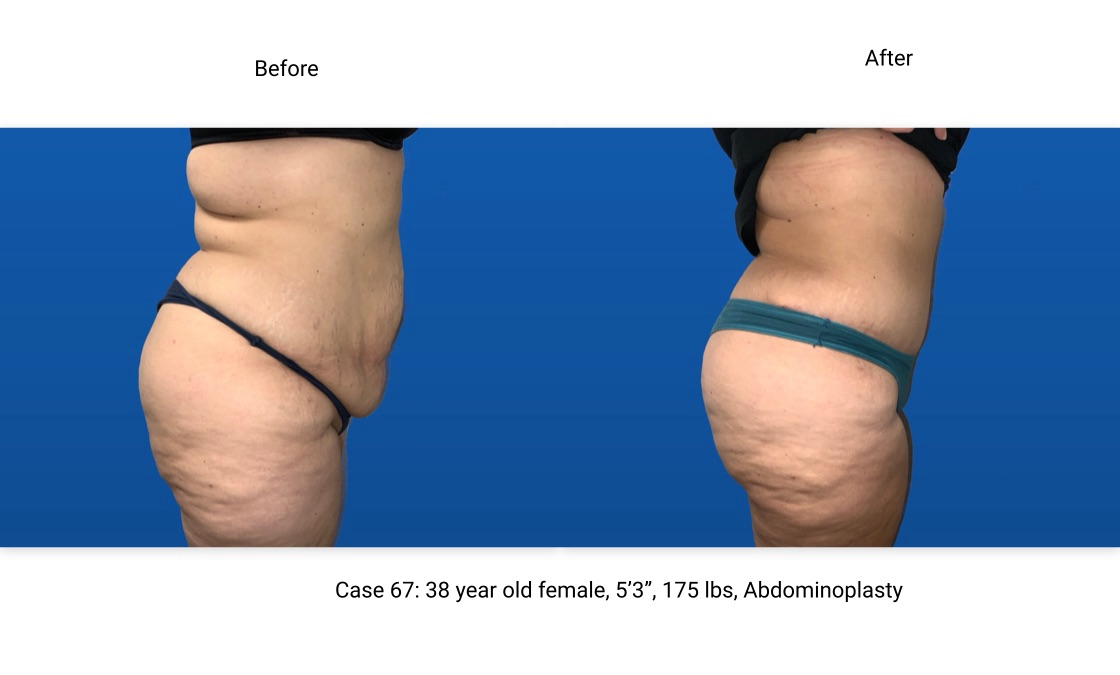 Case 67 Abdominoplasty Side View