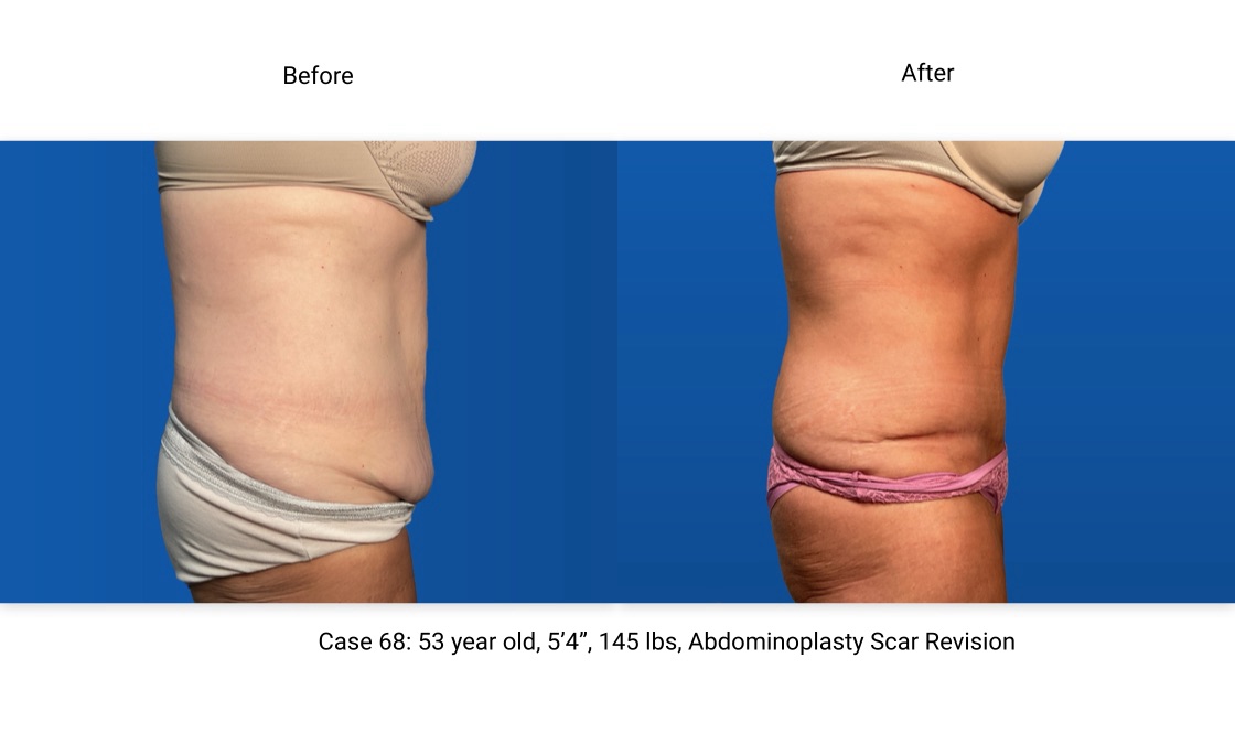 Case 68 Abdominoplasty Front View