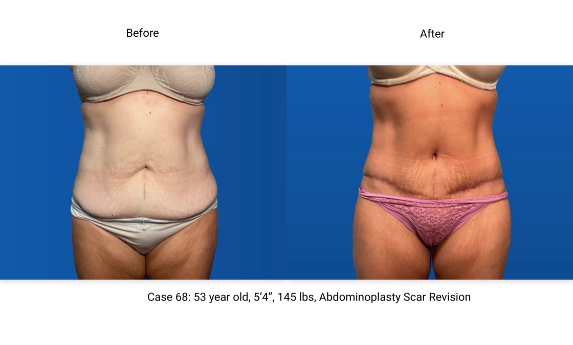 Case 68 Abdominoplasty Side View