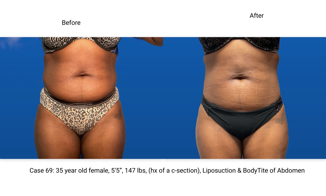 Case 69 Liposuction BodyTite Mini Abdominoplasty Front View