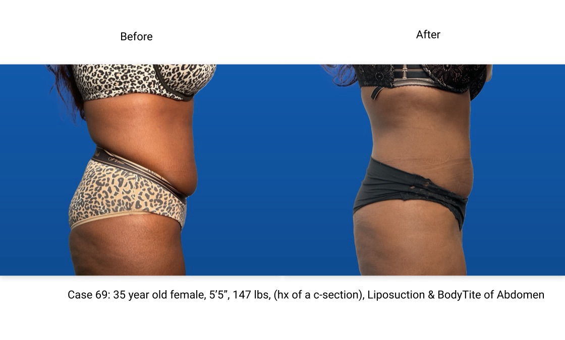Case 69 Liposuction BodyTite Mini Abdominoplasty Side View