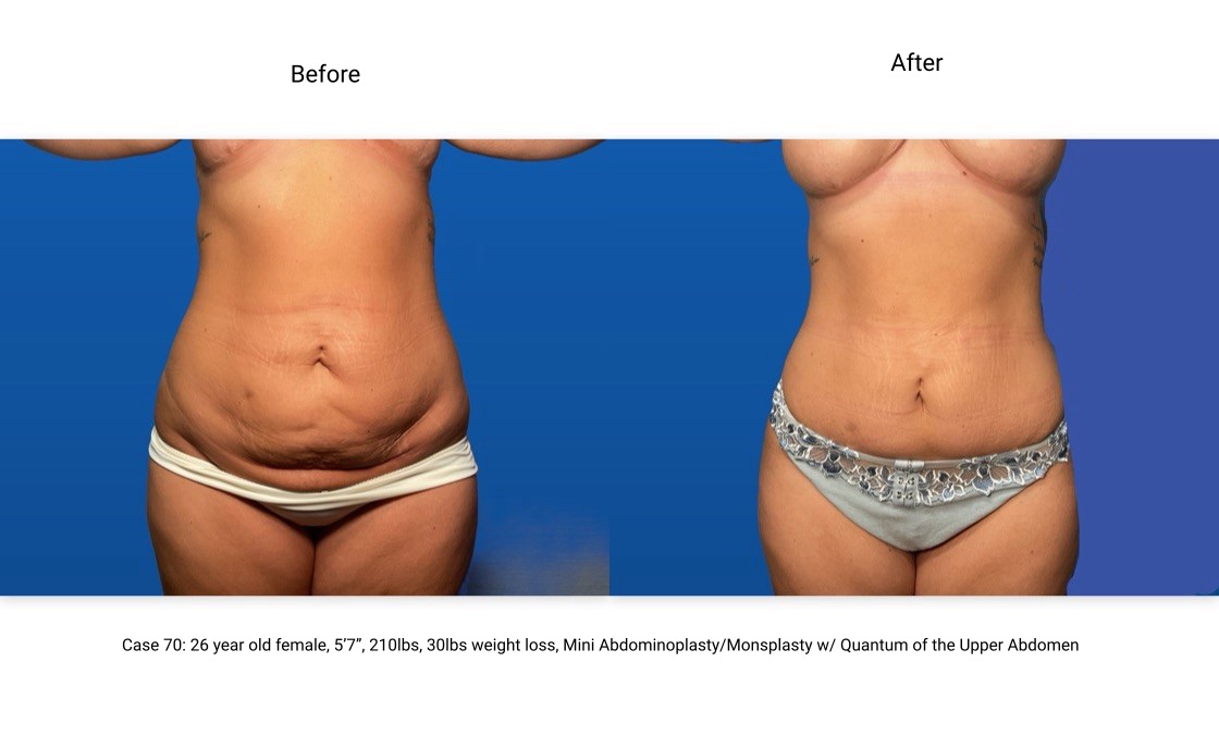 Case 70 Liposuction BodyTite Mini Abdominoplasty Front View