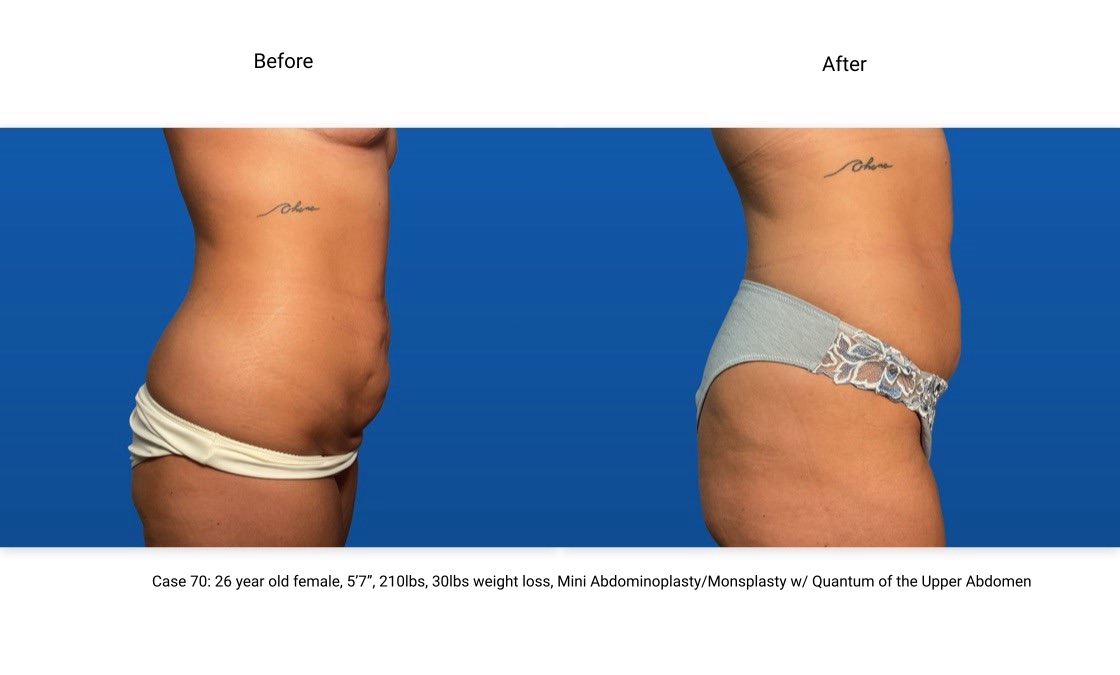 Case 70 Liposuction BodyTite Mini Abdominoplasty Side View