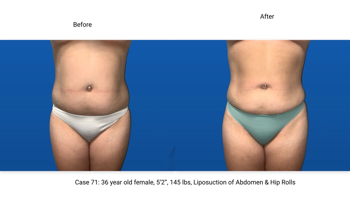 Case 71 Liposuction BodyTite Mini Abdominoplasty Front View