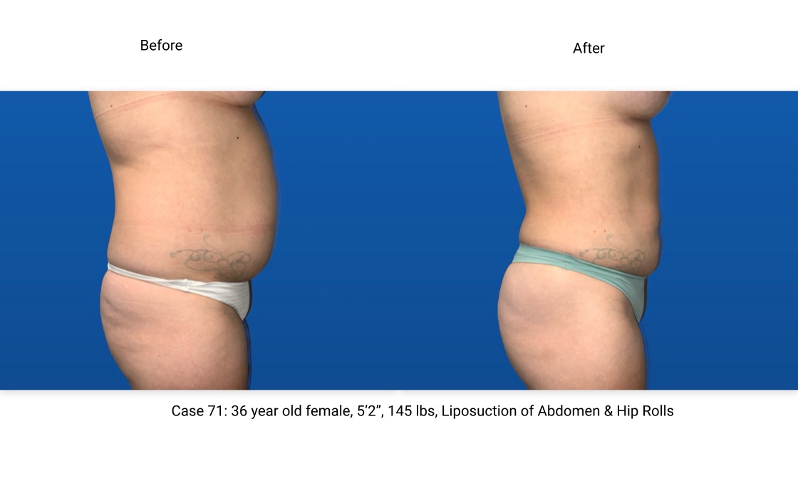 Case 71 Liposuction BodyTite Mini Abdominoplasty Side View