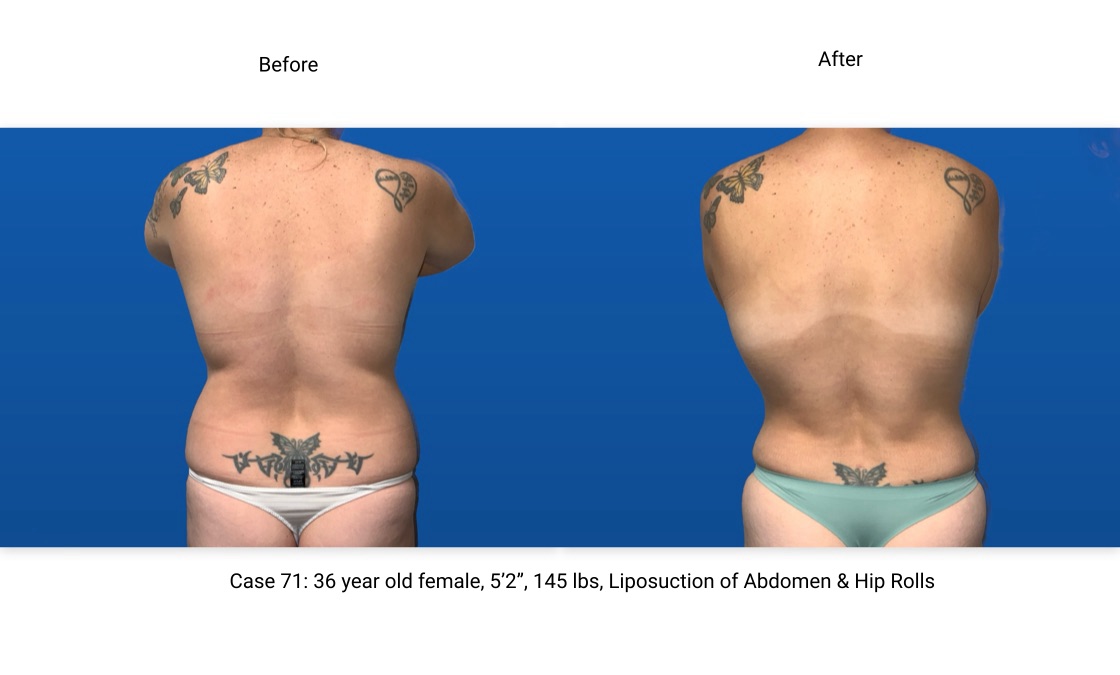 Case 71 Liposuction BodyTite Mini Abdominoplasty Back View