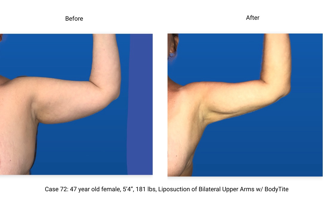 Case 72 Liposuction BodyTite Left Arm Front View
