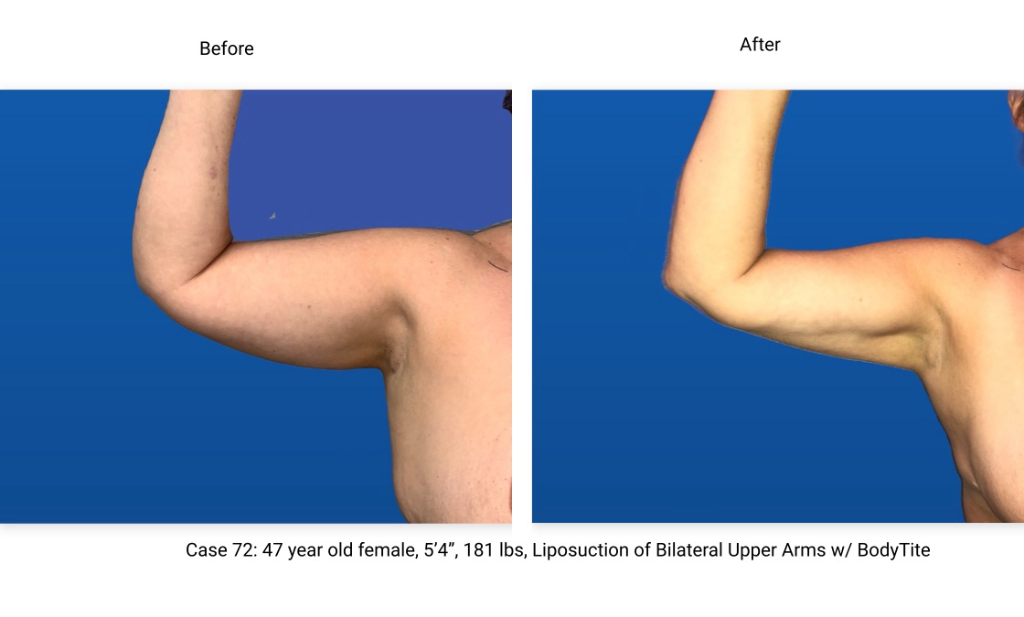 Case 72 Liposuction BodyTite Right Arm Front View